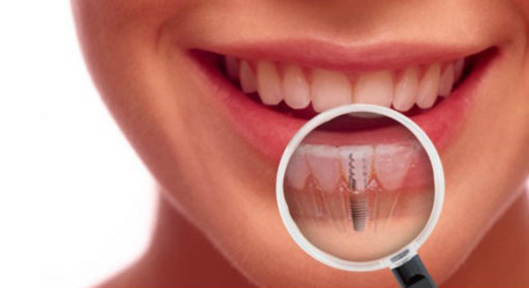 dental-implant-img