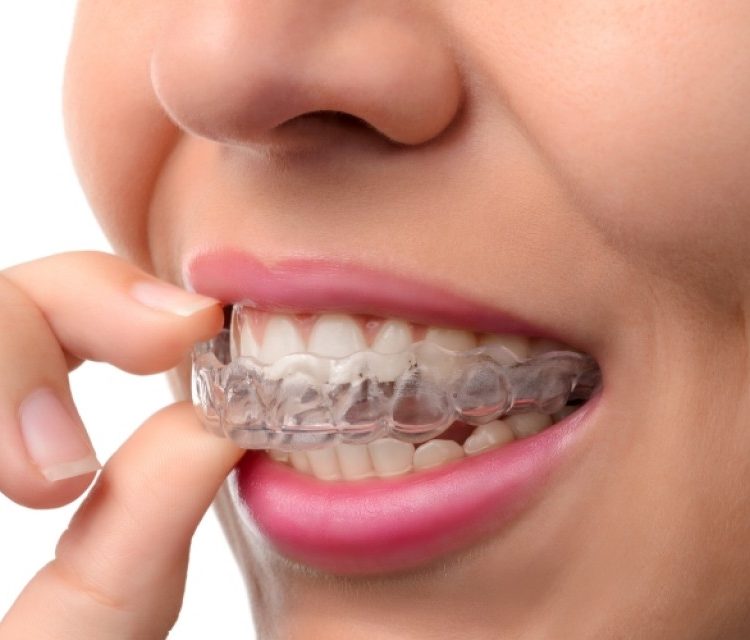 mouthguardimg
