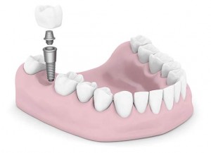 rootcanal